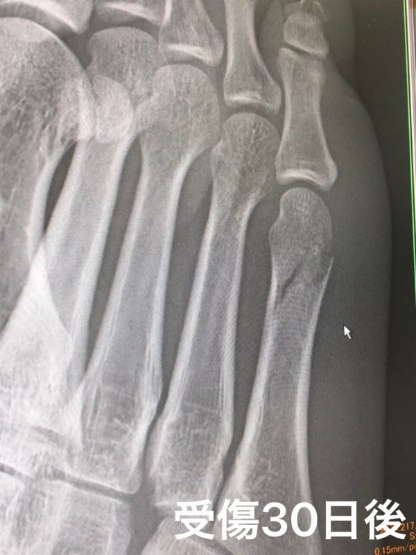 第五中足骨骨折完治 足の指の甲が骨折してから歩ける全治までの経過を写真と共に公開 歩き方は カップルブログ たこみそ