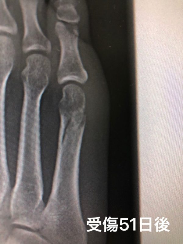 第五中足骨骨折完治 足の指の甲が骨折してから歩ける全治までの経過を写真と共に公開 歩き方は カップルブログ たこみそ